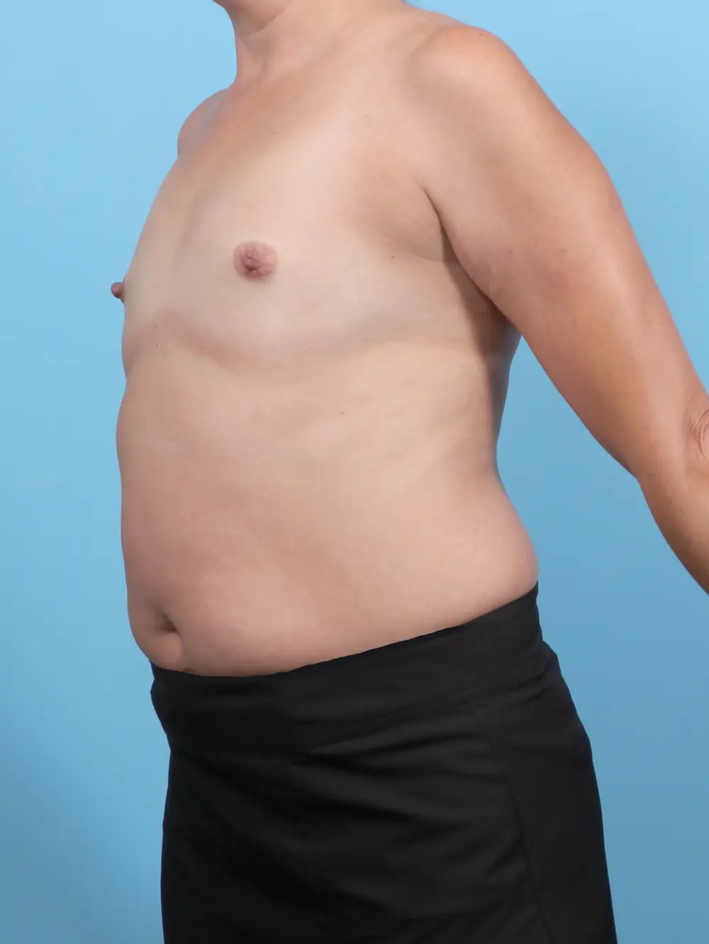 Breast Augmentation Patient Photo - Case 52744 - before view-1