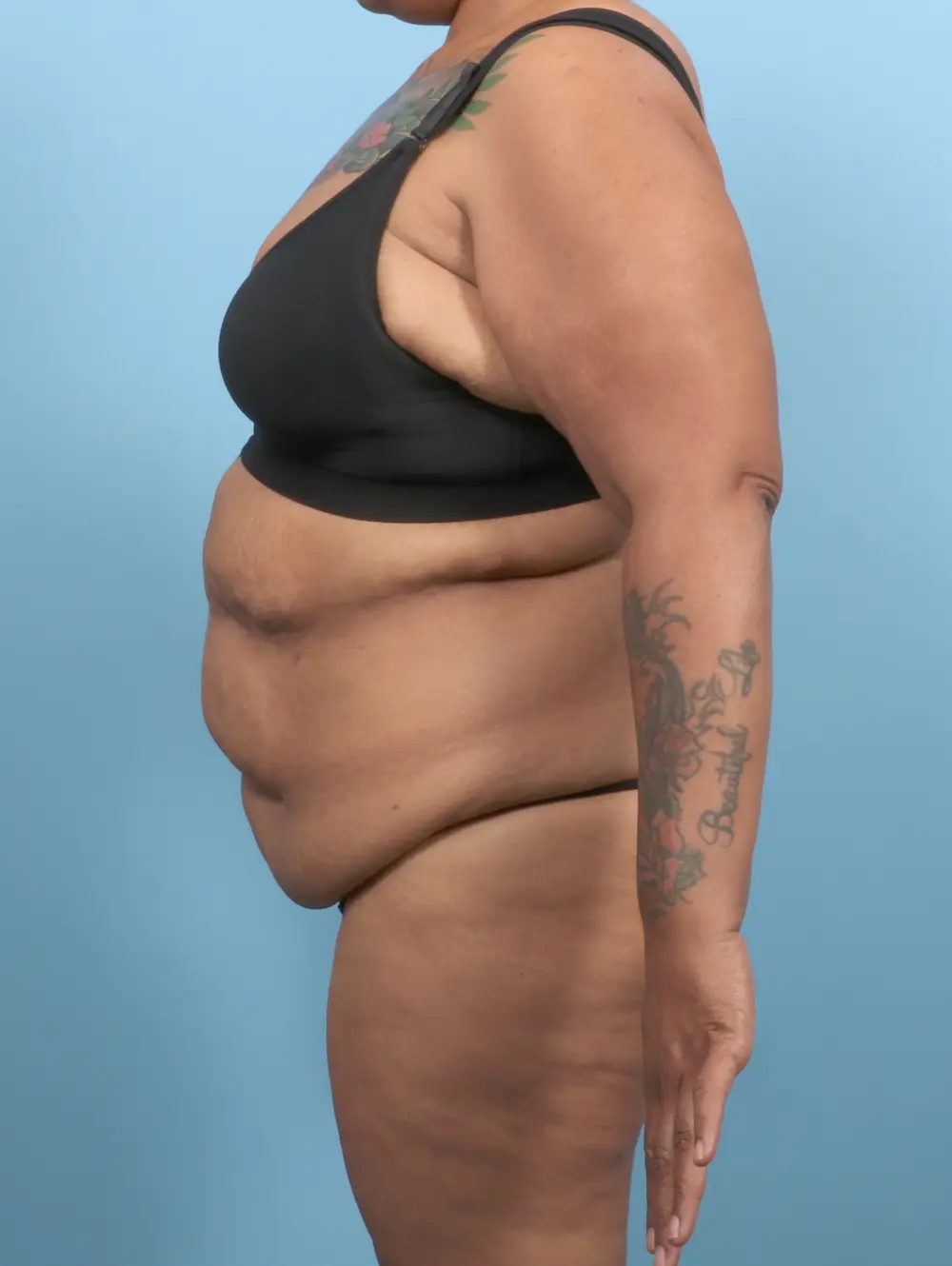 After Weight Loss Patient Photo - Case 52752 - before view-2