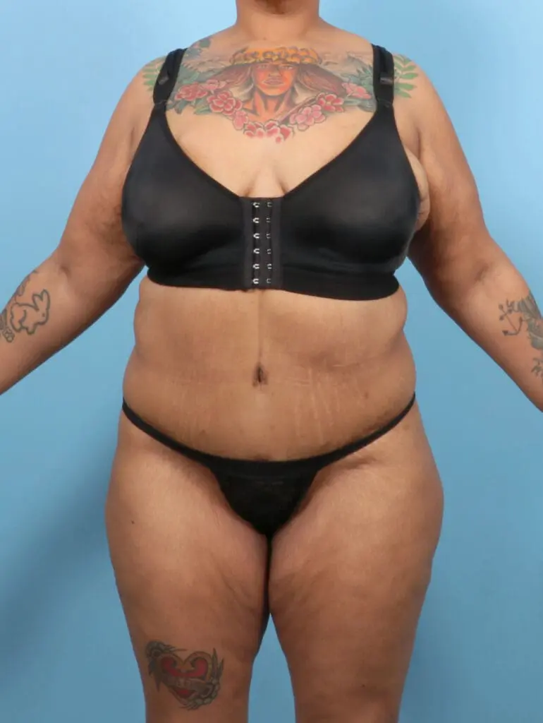 After Weight Loss - Case 52752 - After