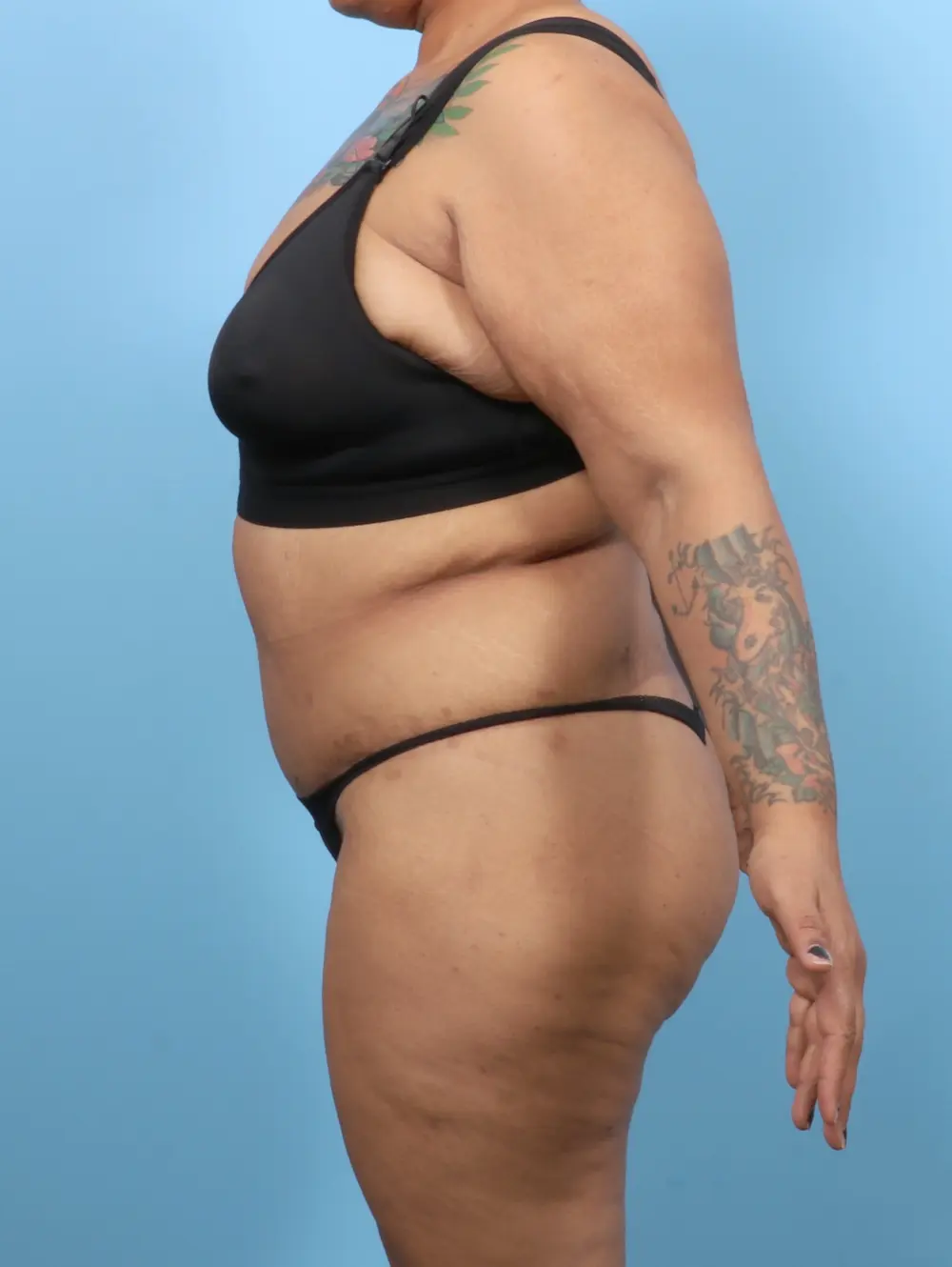 After Weight Loss Patient Photo - Case 52752 - after view-2