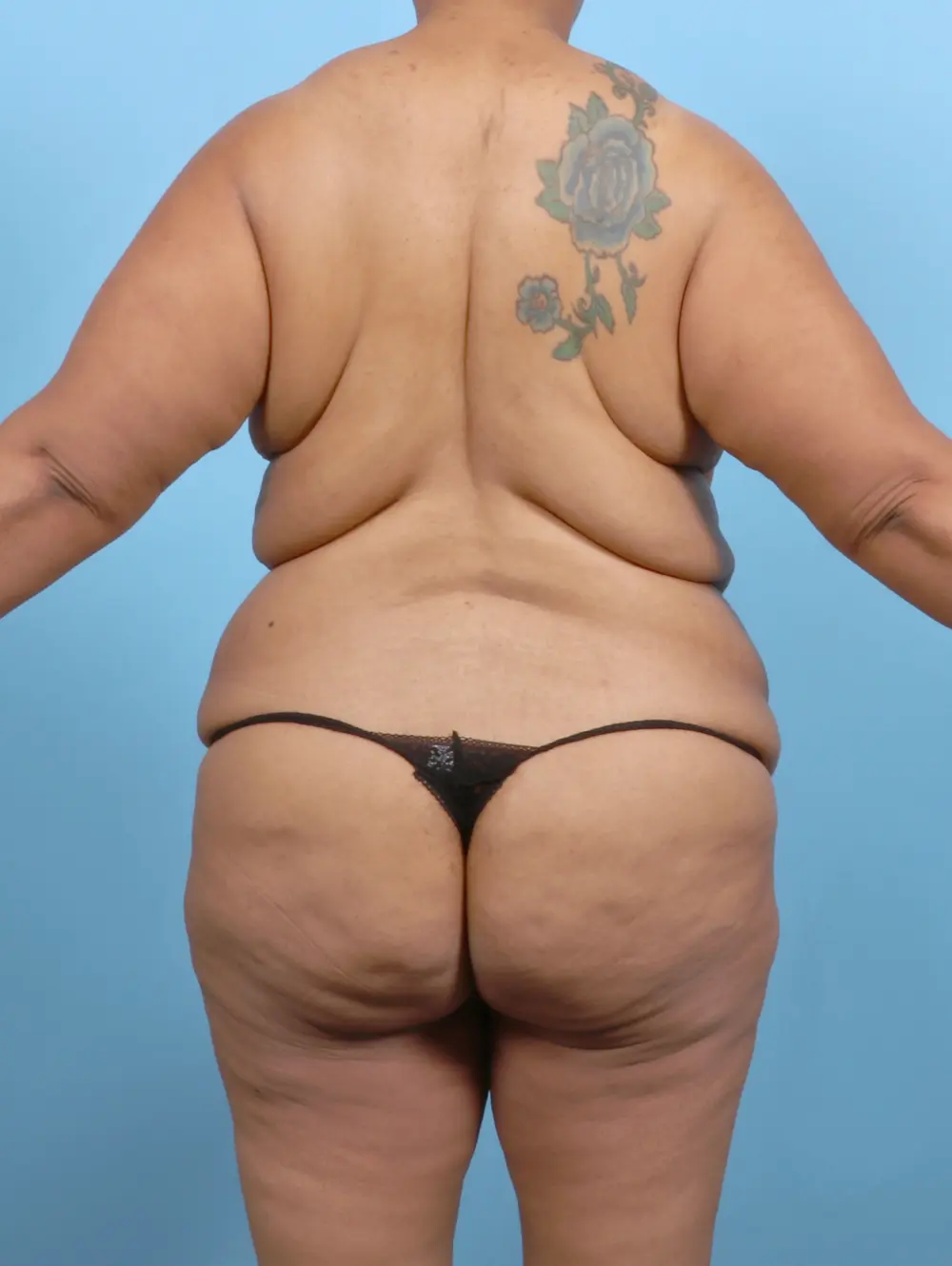 After Weight Loss Patient Photo - Case 52752 - before view-3
