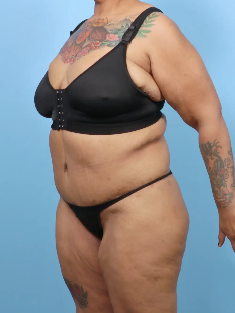 After Weight Loss Patient Photo - Case 52752 - after view-1