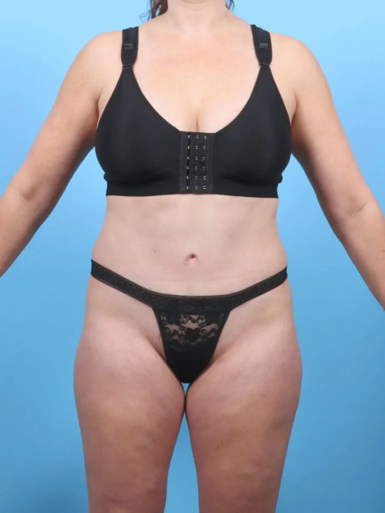 Tummy Tuck - Case 52798 - After