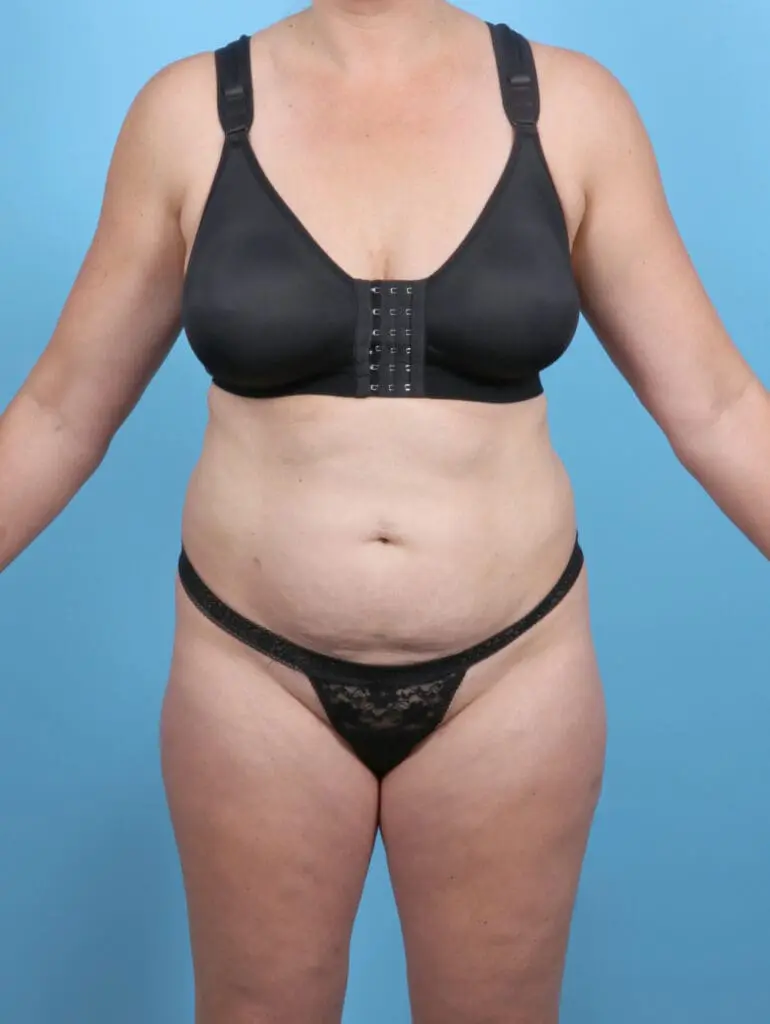 Tummy Tuck - Case 52798 - Before