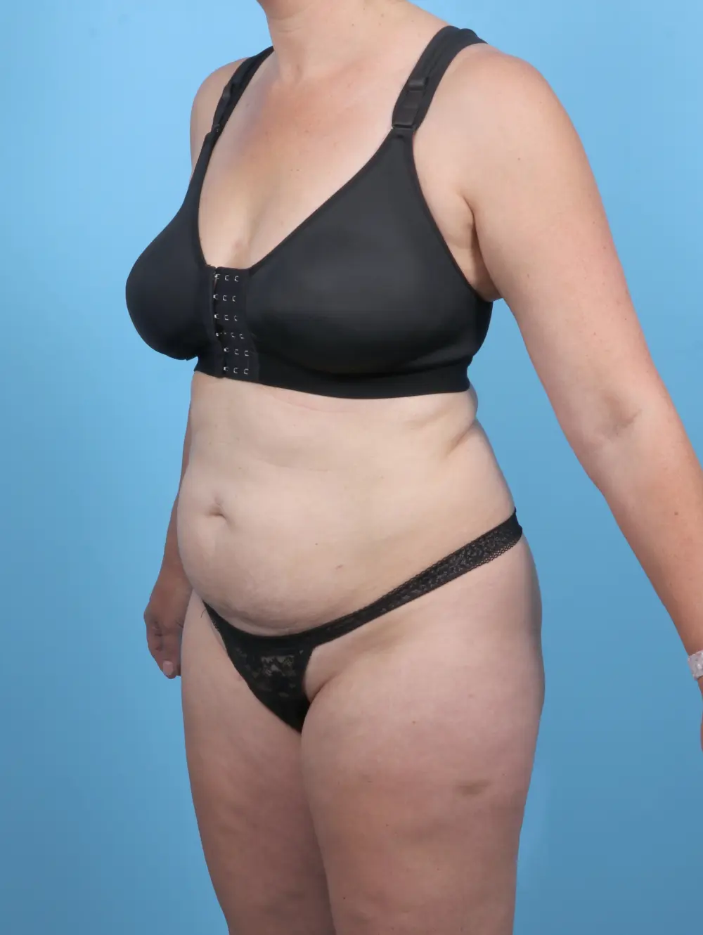 Tummy Tuck Patient Photo - Case 52798 - before view-1
