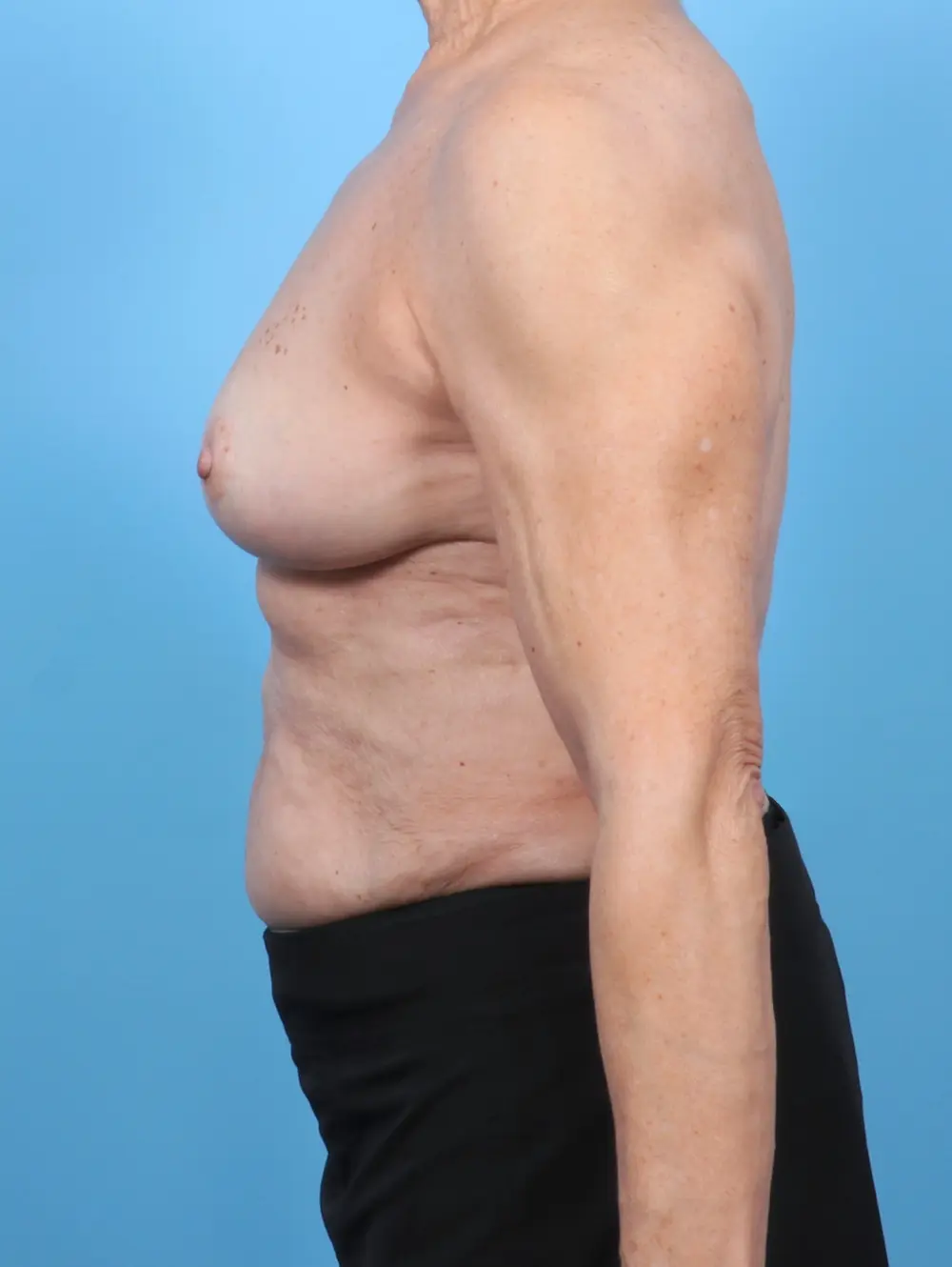 Breast Lift/Reduction w/o Implants Patient Photo - Case 52816 - after view-2