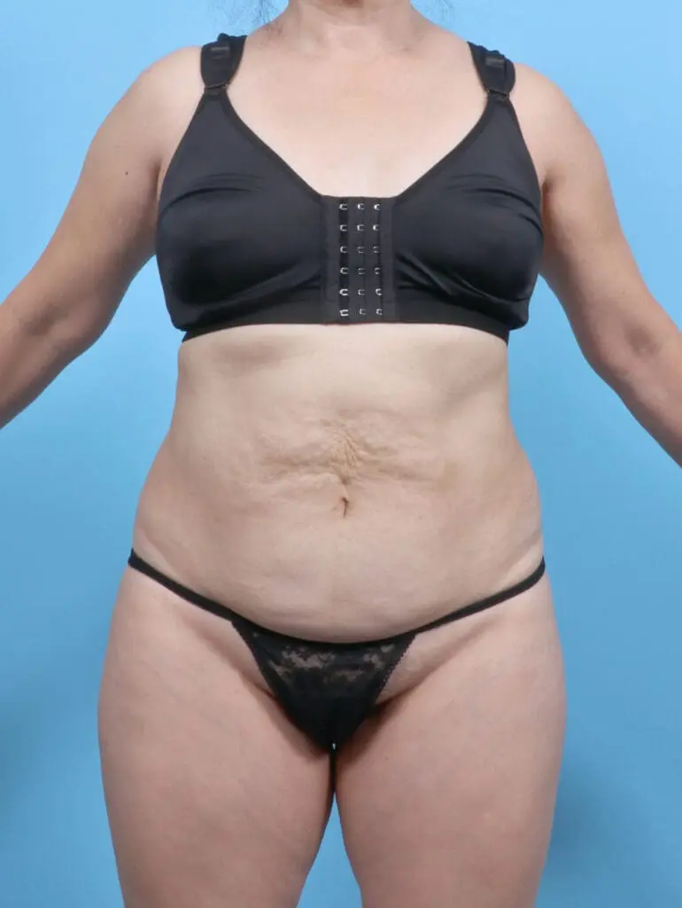 Tummy Tuck - Case 52881 - Before