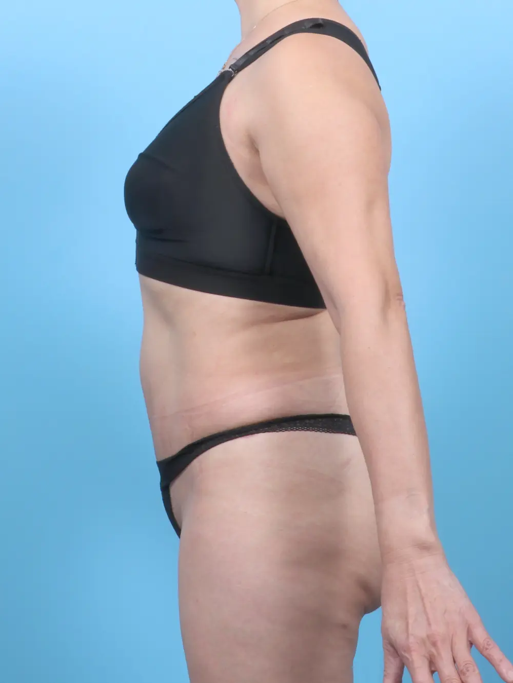 Tummy Tuck Patient Photo - Case 52881 - after view-2