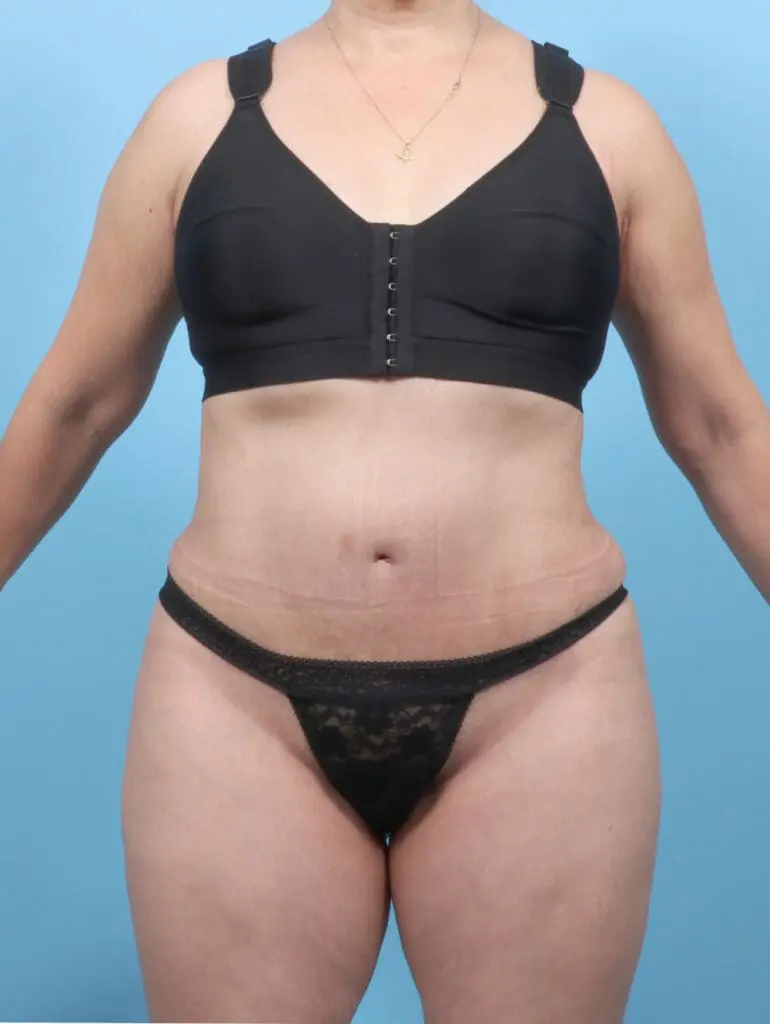 Tummy Tuck - Case 52881 - After