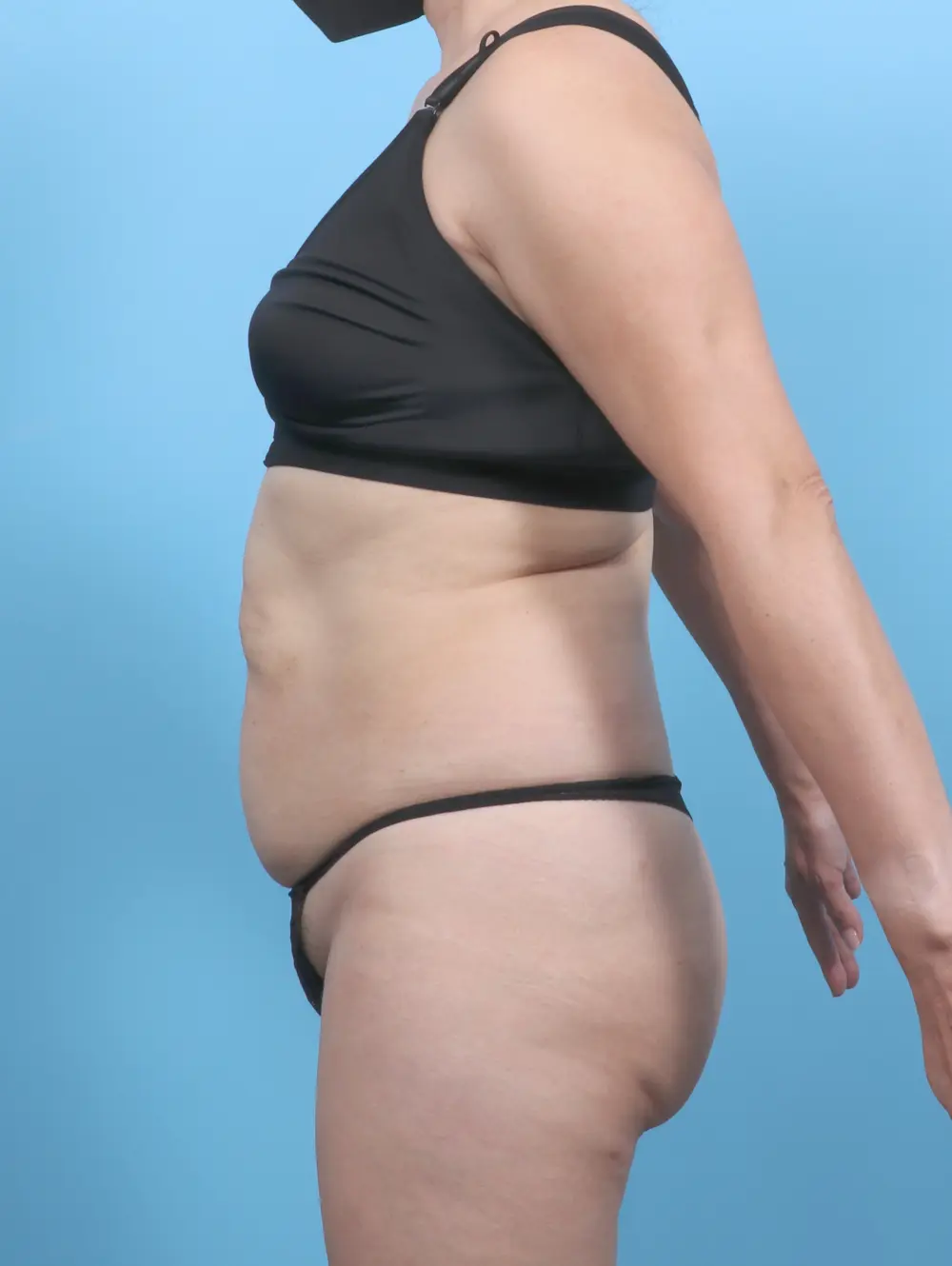 Tummy Tuck Patient Photo - Case 52881 - before view-2