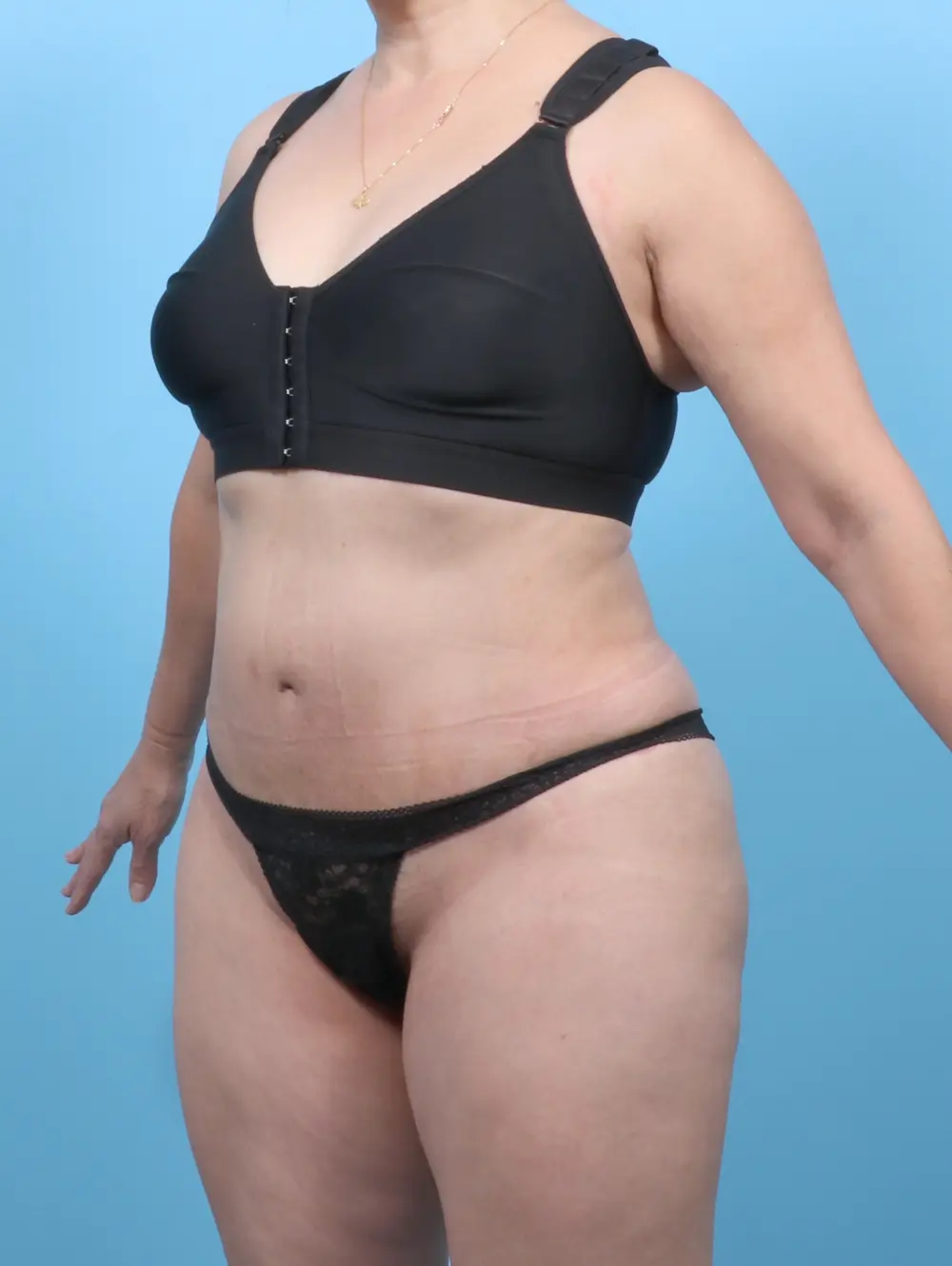 Tummy Tuck Patient Photo - Case 52881 - after view-1