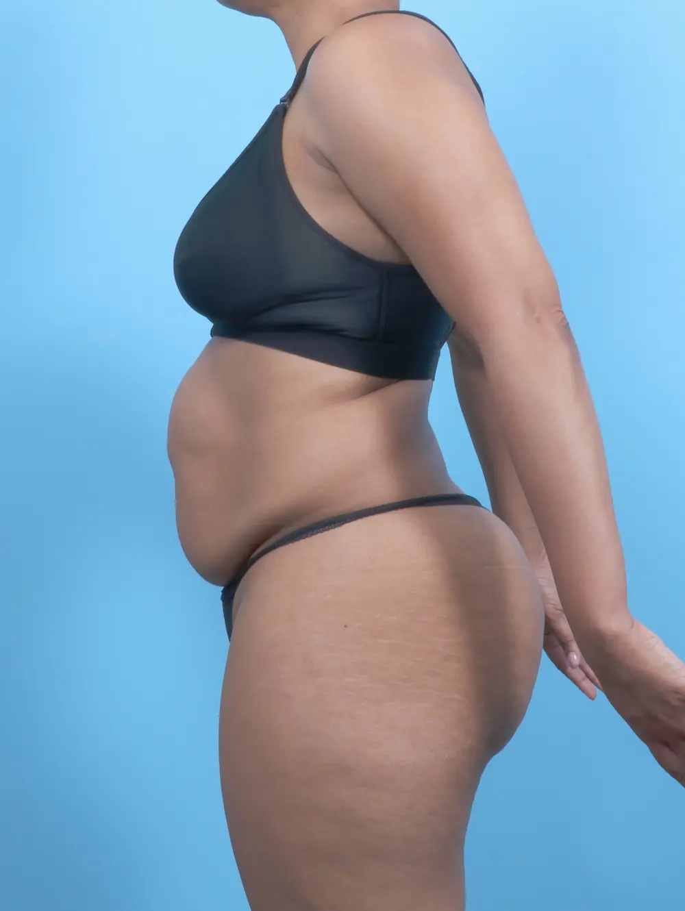 Tummy Tuck Patient Photo - Case 52899 - before view-2