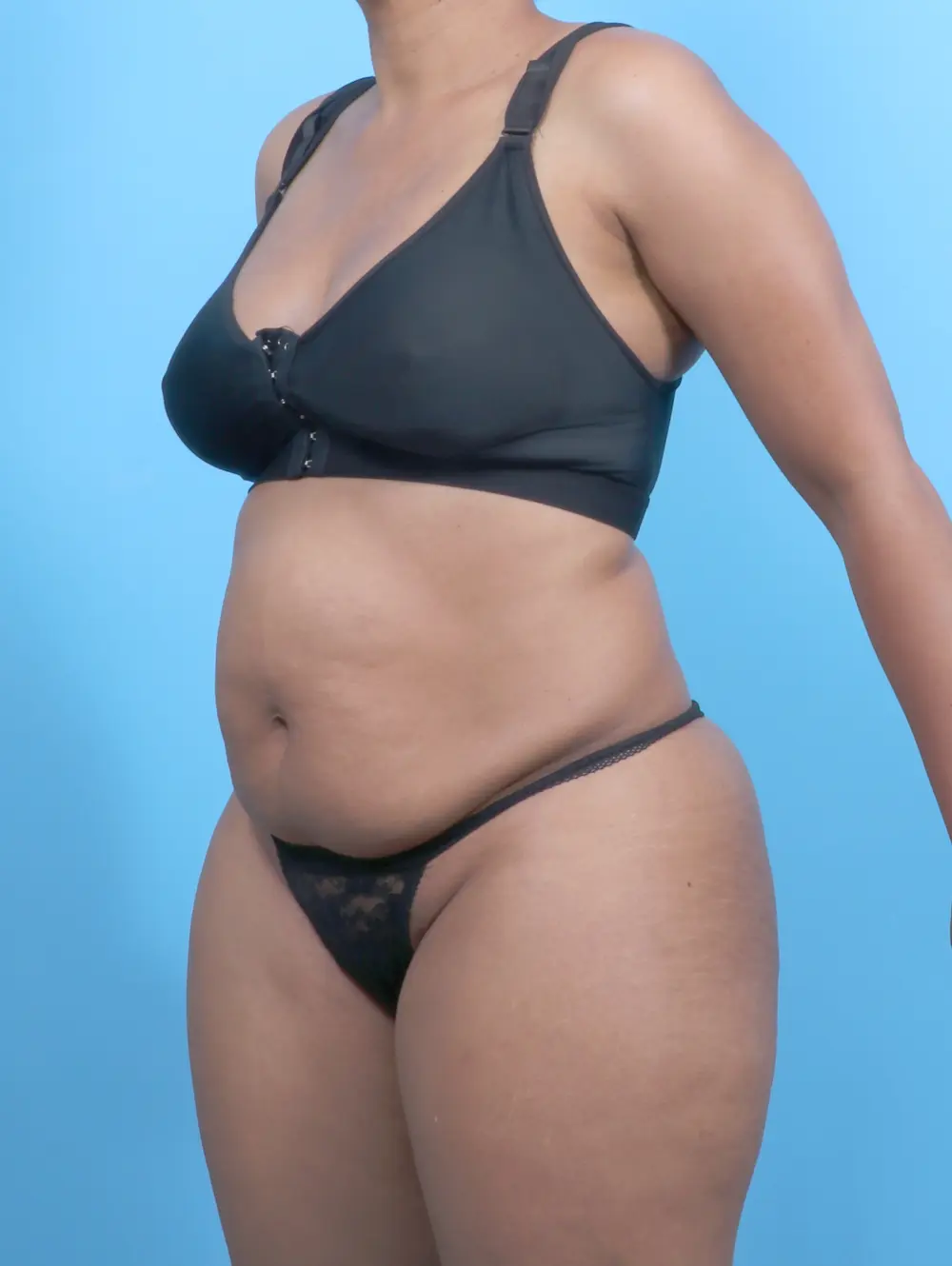 Tummy Tuck Patient Photo - Case 52899 - before view-1