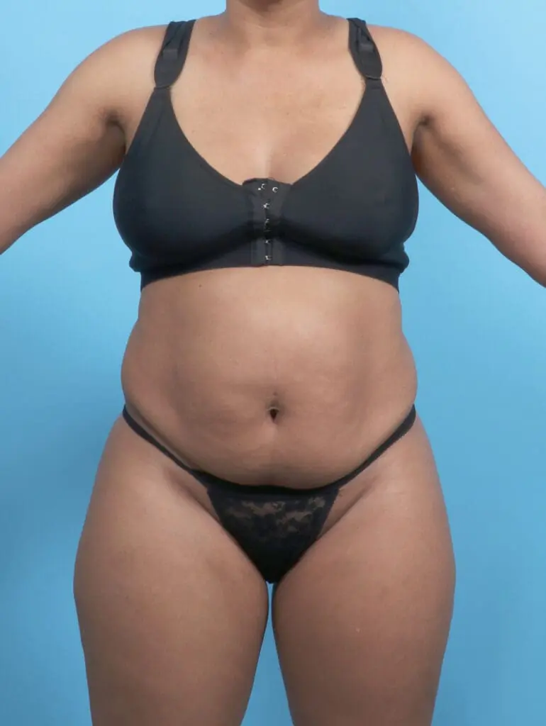 Tummy Tuck - Case 52899 - Before