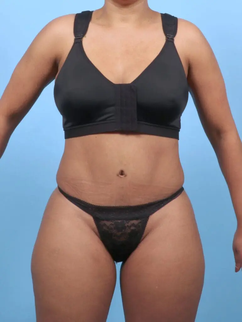 Tummy Tuck - Case 52899 - After