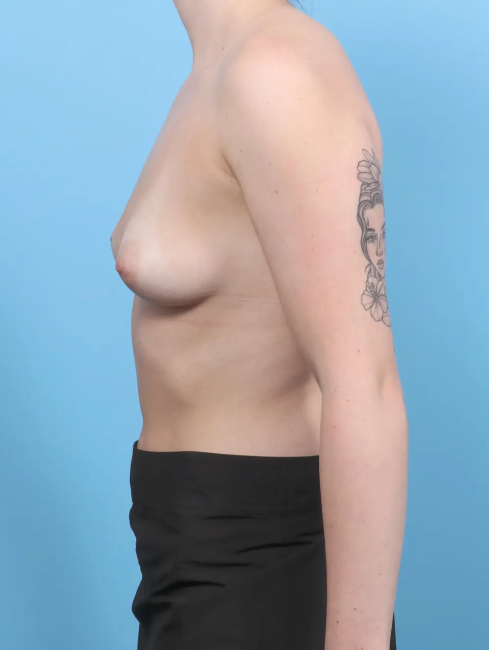 Breast Augmentation Patient Photo - Case 52909 - before view-2