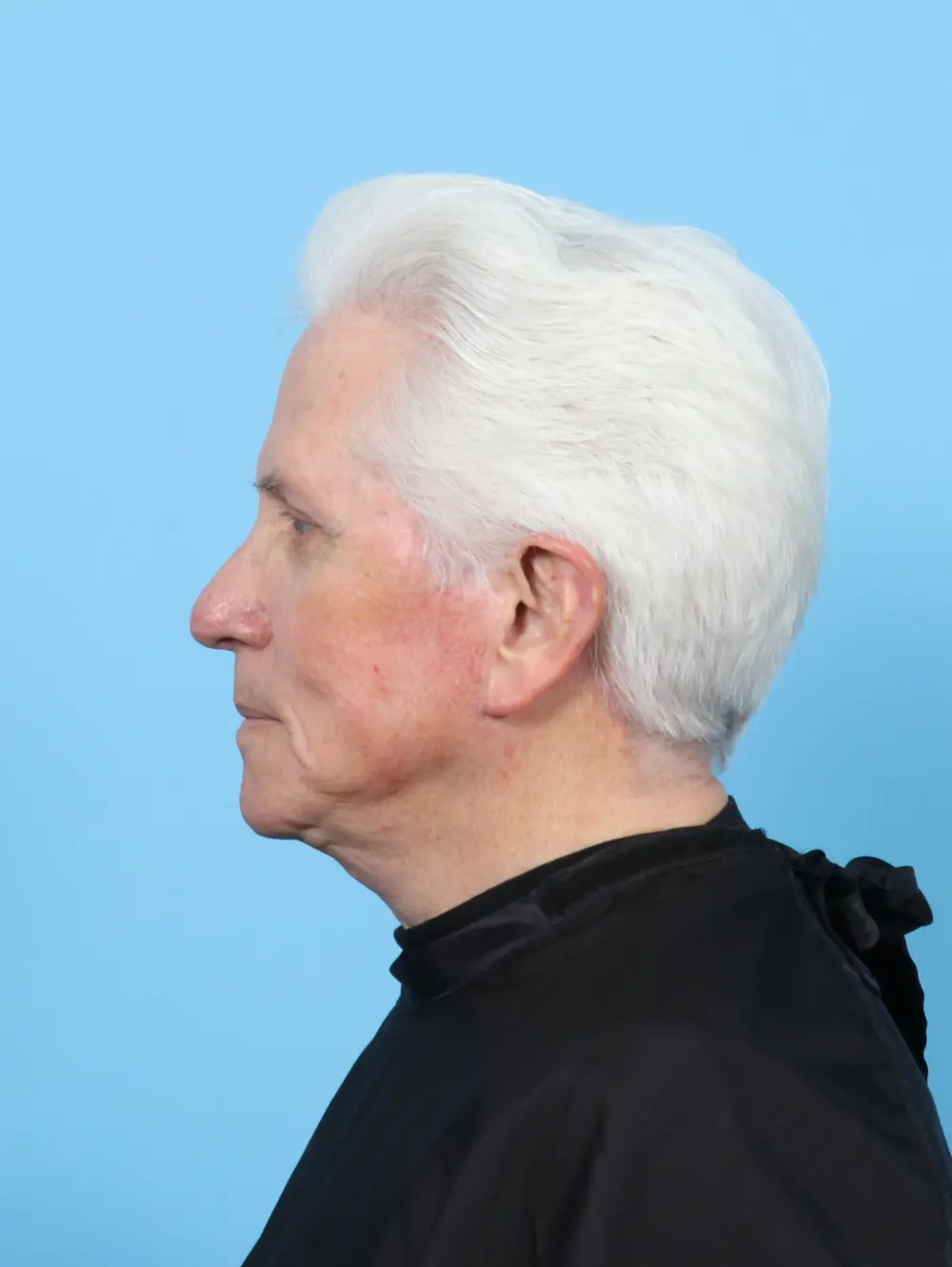 Facelift / Neck Lift Patient Photo - Case 52918 - after view-2