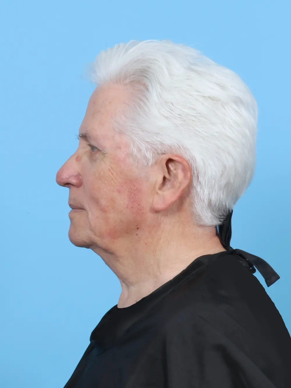 Facelift / Neck Lift Patient Photo - Case 52918 - before view-2