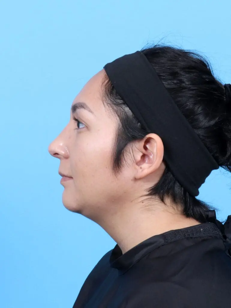 Rhinoplasty - Case 52953 - After