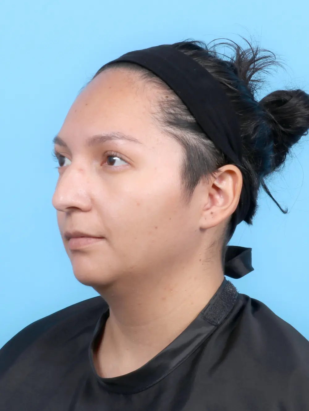 Rhinoplasty Patient Photo - Case 52953 - before view-1