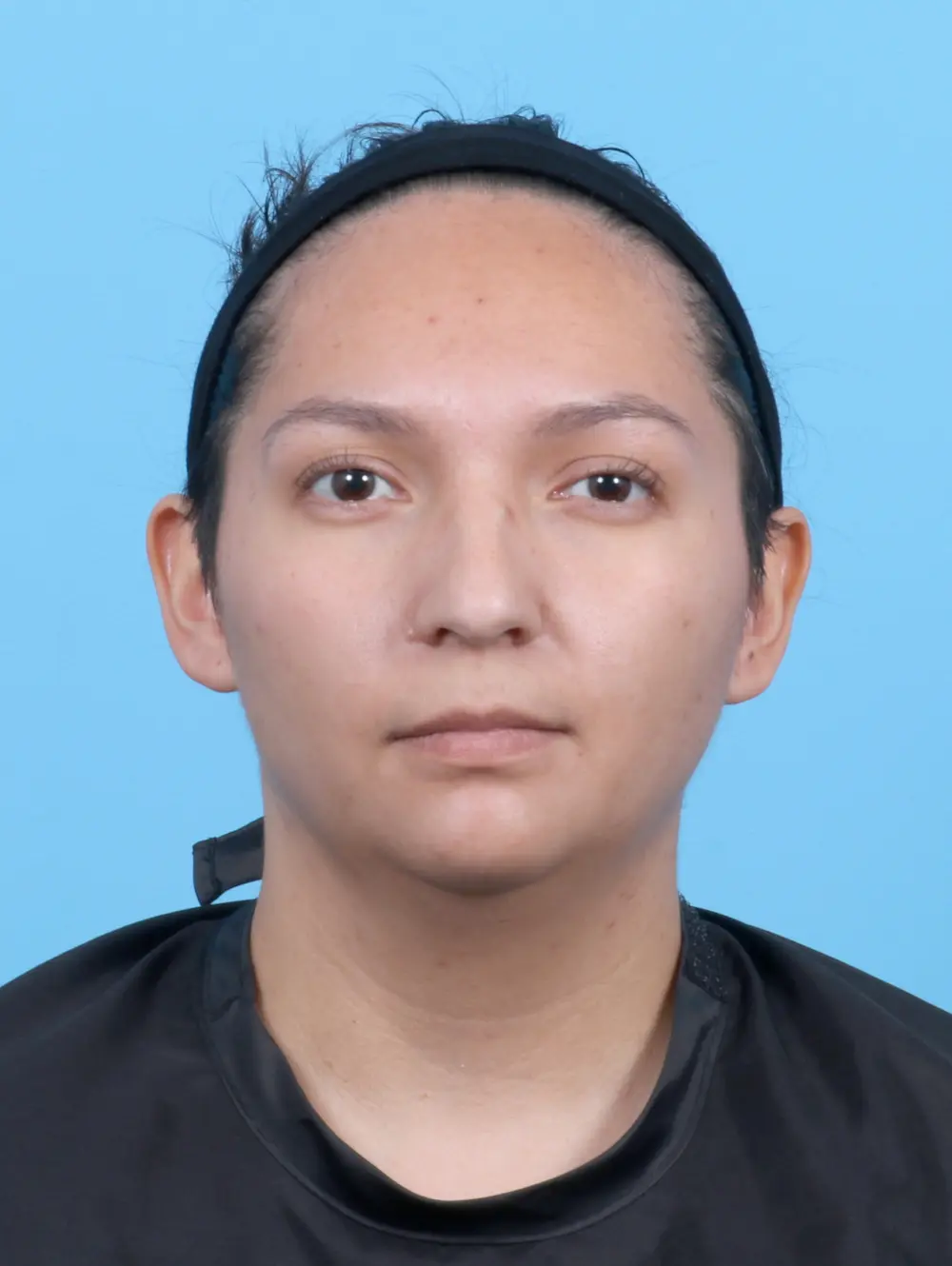 Rhinoplasty Patient Photo - Case 52953 - before view-2
