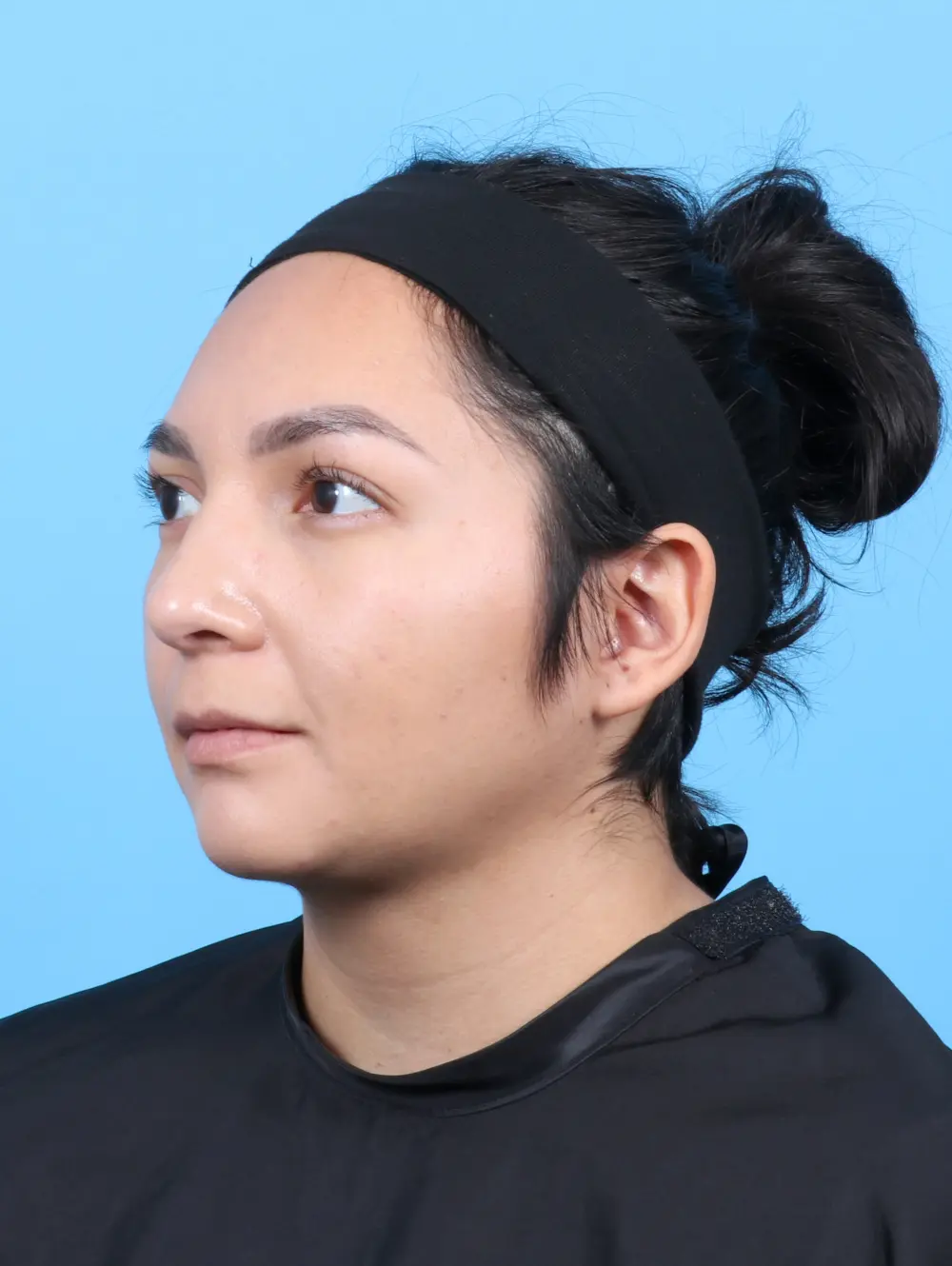 Rhinoplasty Patient Photo - Case 52953 - after view-1
