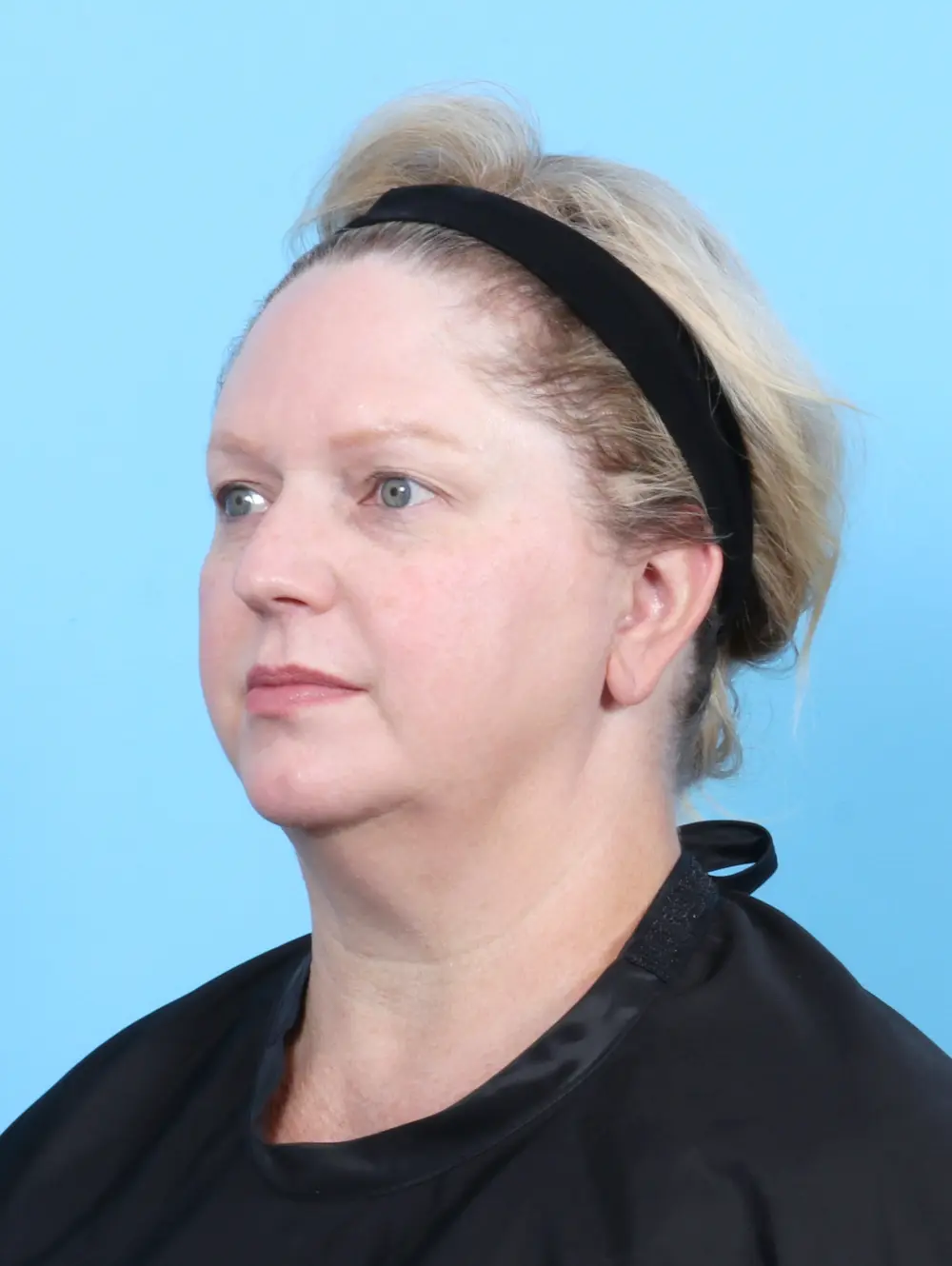 Eyelid Surgery Patient Photo - Case 52961 - before view-1