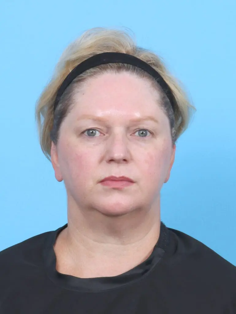 Eyelid Surgery - Case 52961 - Before