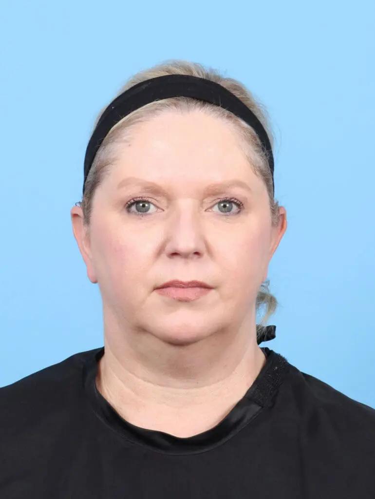 Eyelid Surgery - Case 52961 - After