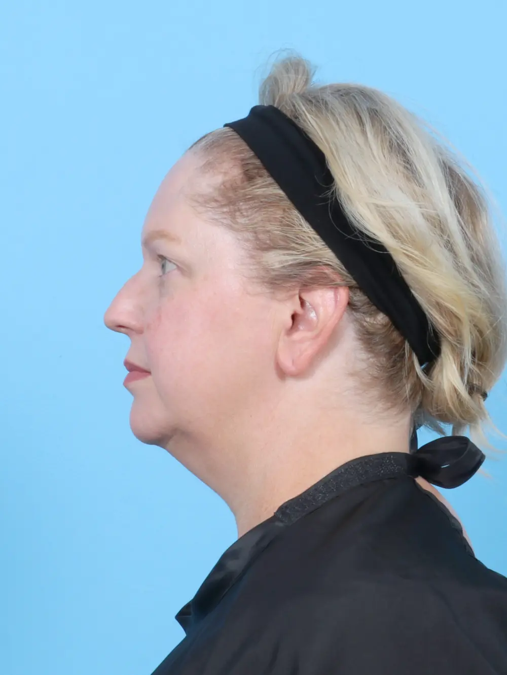 Eyelid Surgery Patient Photo - Case 52961 - before view-2