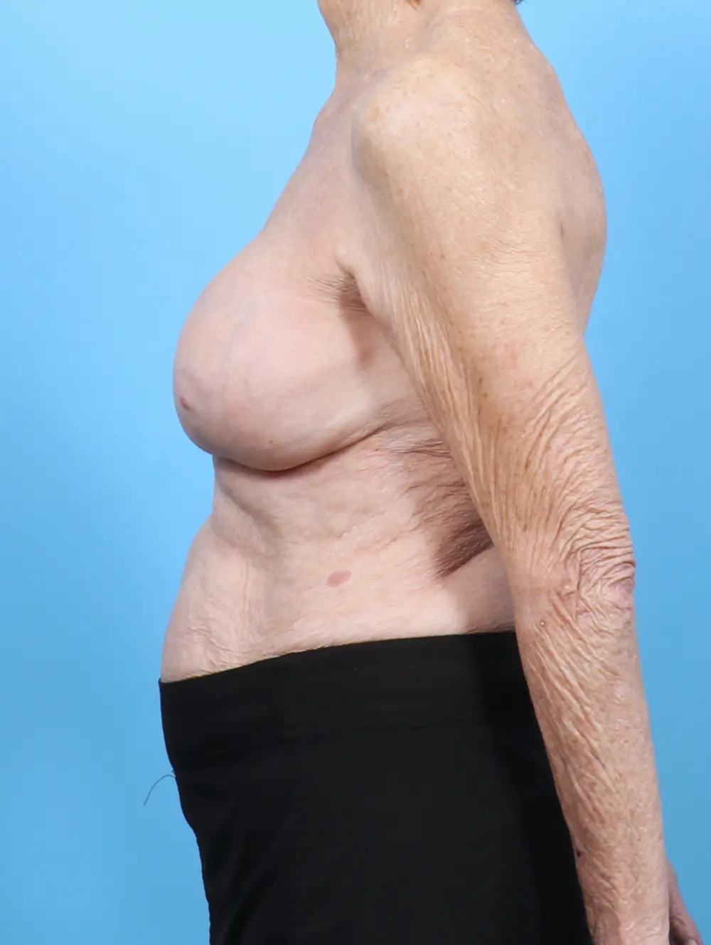 Breast Implant Revision Patient Photo - Case 53003 - after view-2