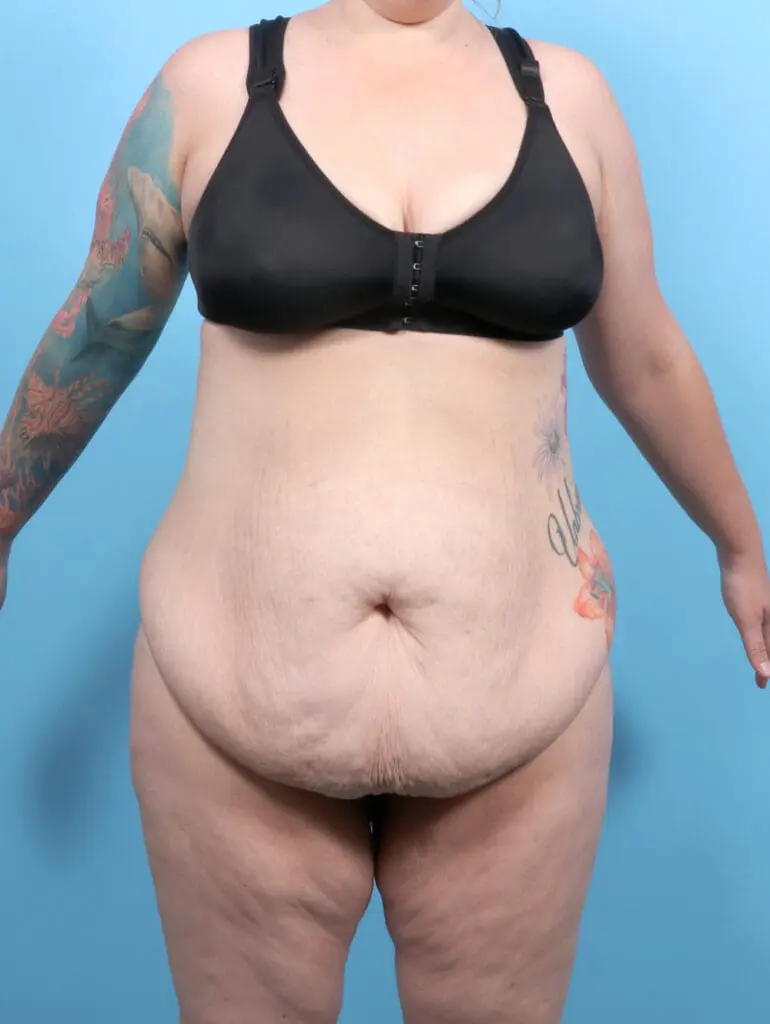 Tummy Tuck - Case 53050 - Before