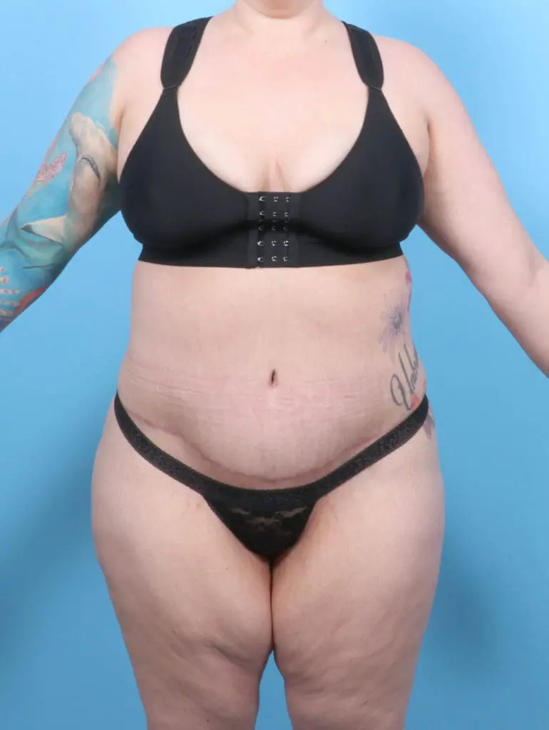 Tummy Tuck - Case 53050 - After