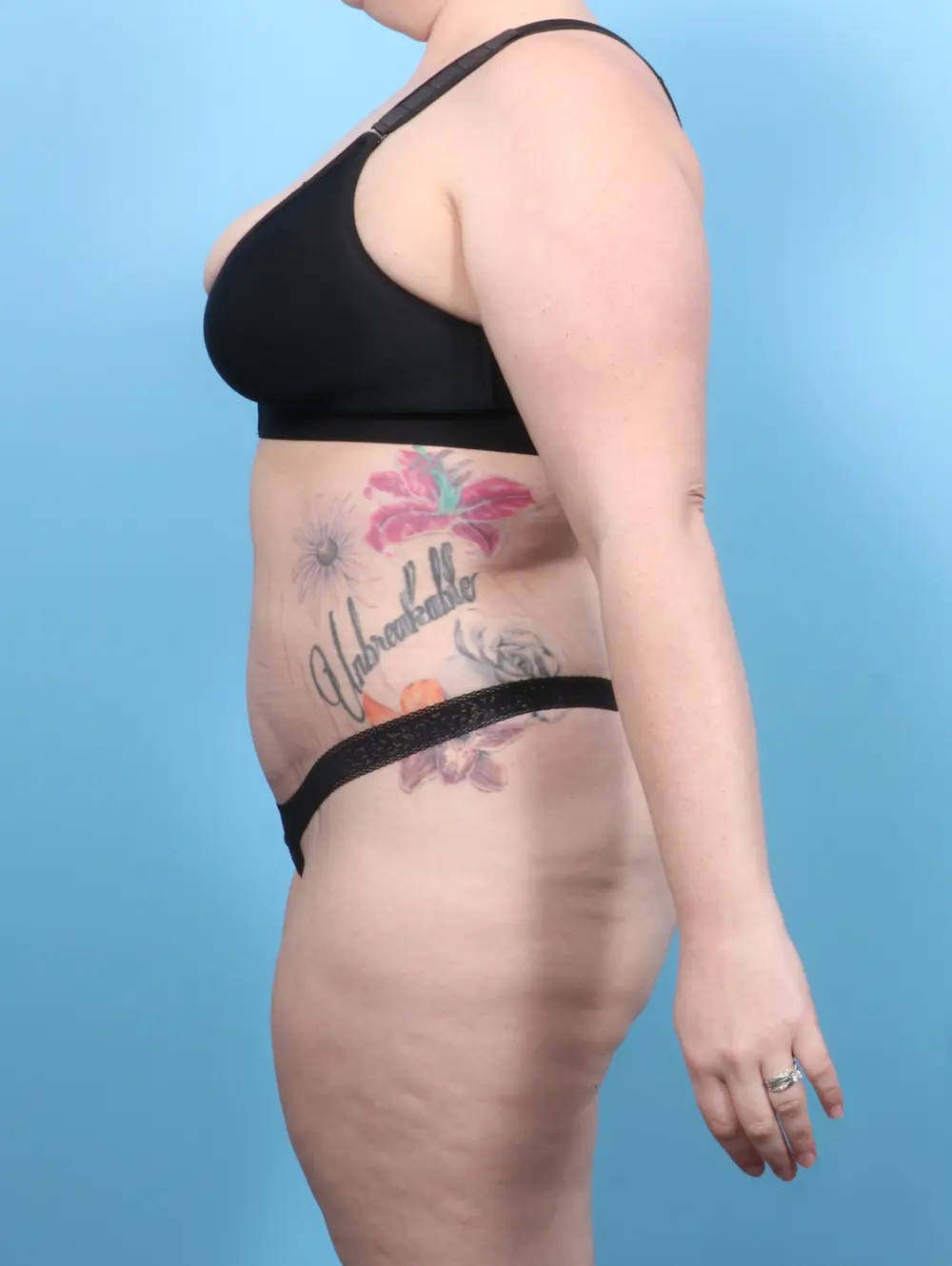 Tummy Tuck Patient Photo - Case 53050 - after view-2