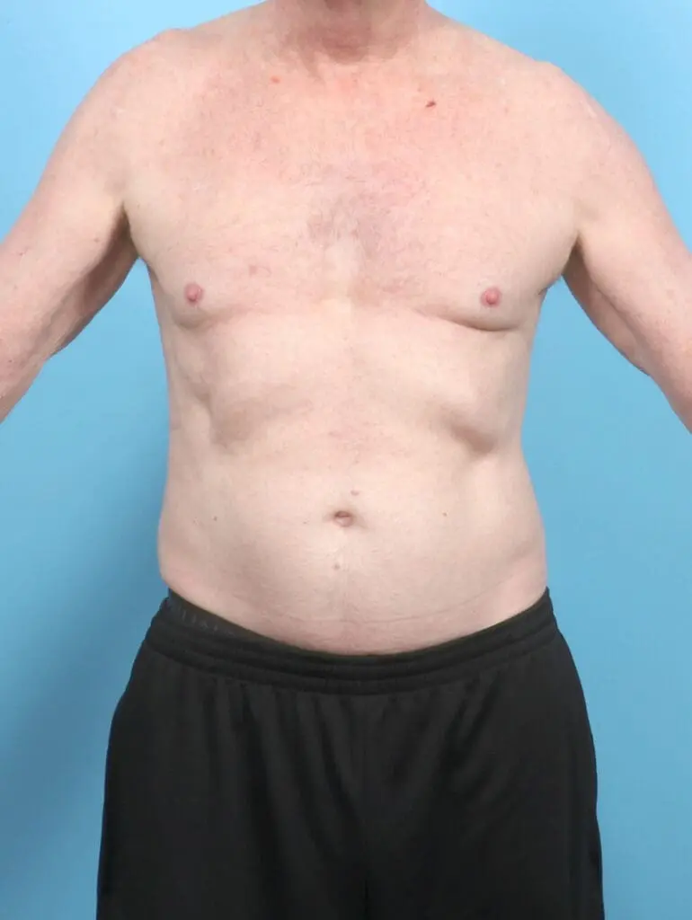 Gynecomastia - Case 53074 - Before