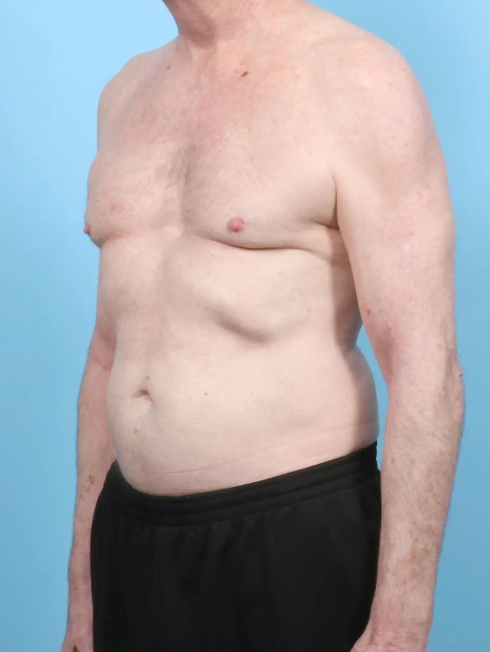Gynecomastia Patient Photo - Case 53074 - before view-1
