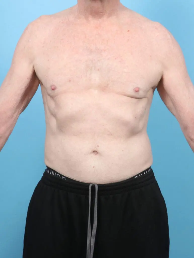 Gynecomastia - Case 53074 - After
