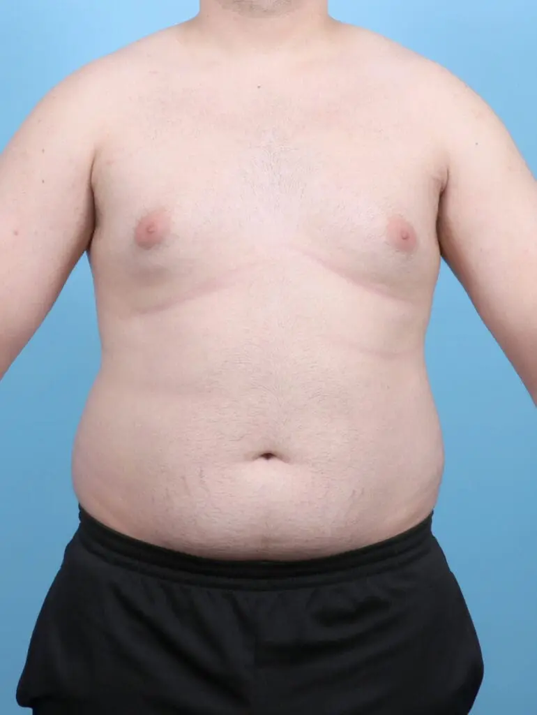 Gynecomastia - Case 53090 - Before
