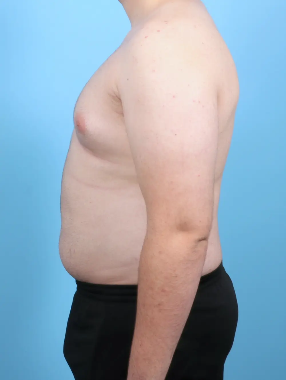 Gynecomastia Patient Photo - Case 53090 - before view-2