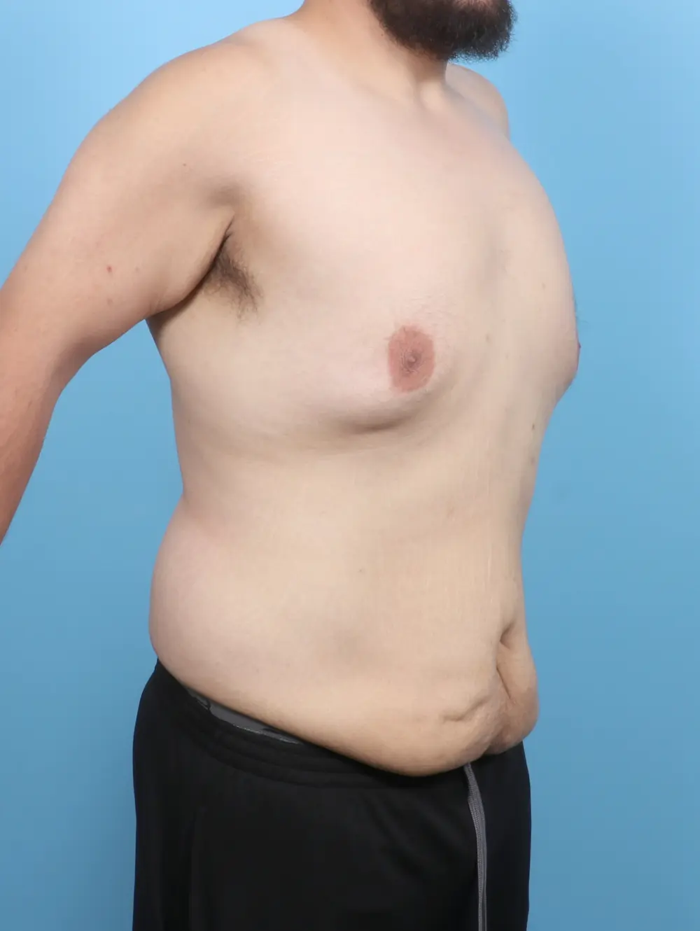 After Weight Loss Patient Photo - Case 53108 - before view-1