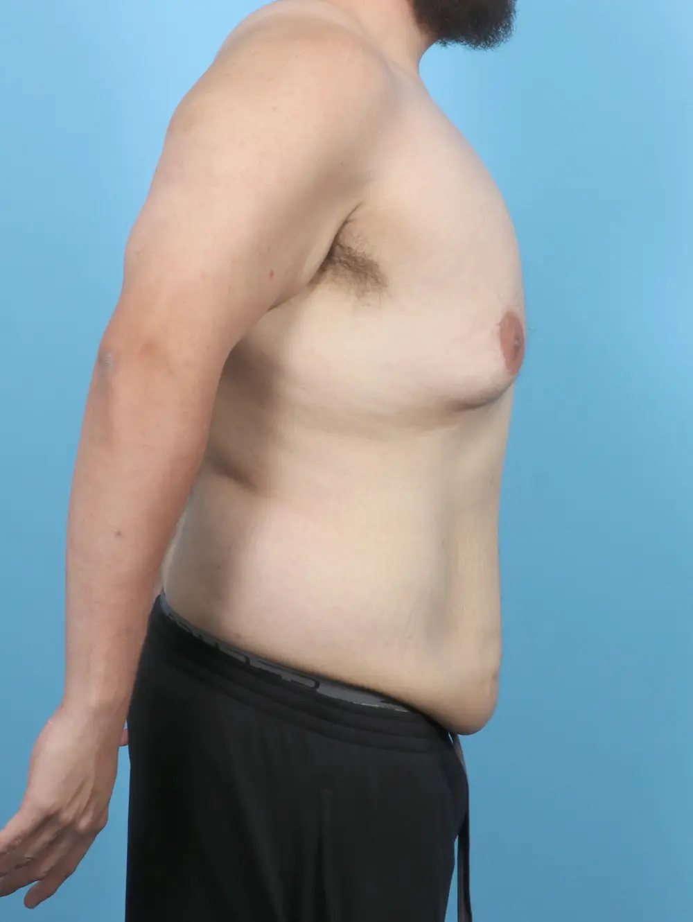 After Weight Loss Patient Photo - Case 53108 - before view-2