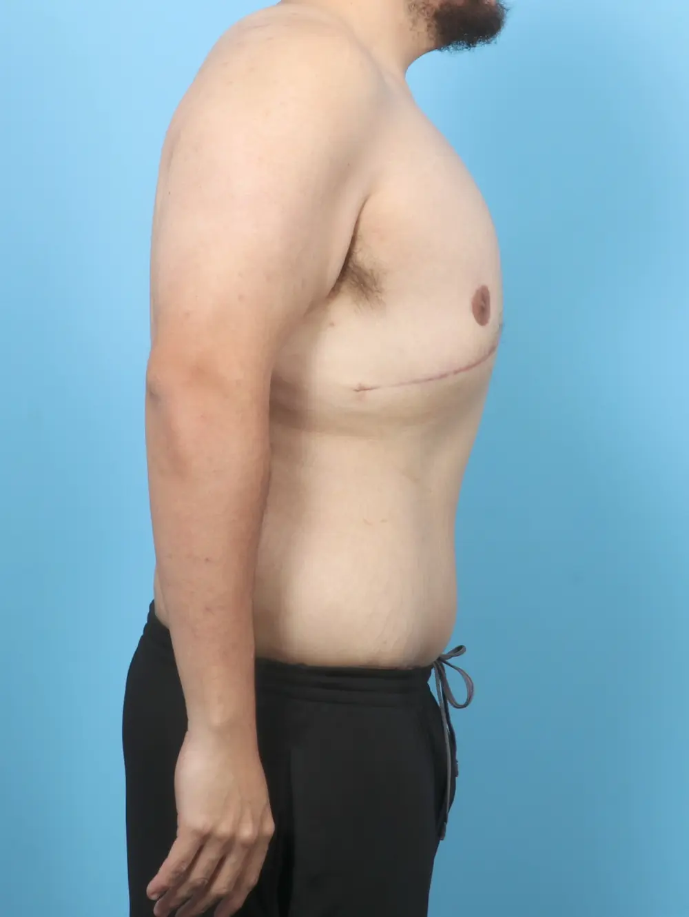 After Weight Loss Patient Photo - Case 53108 - after view-2