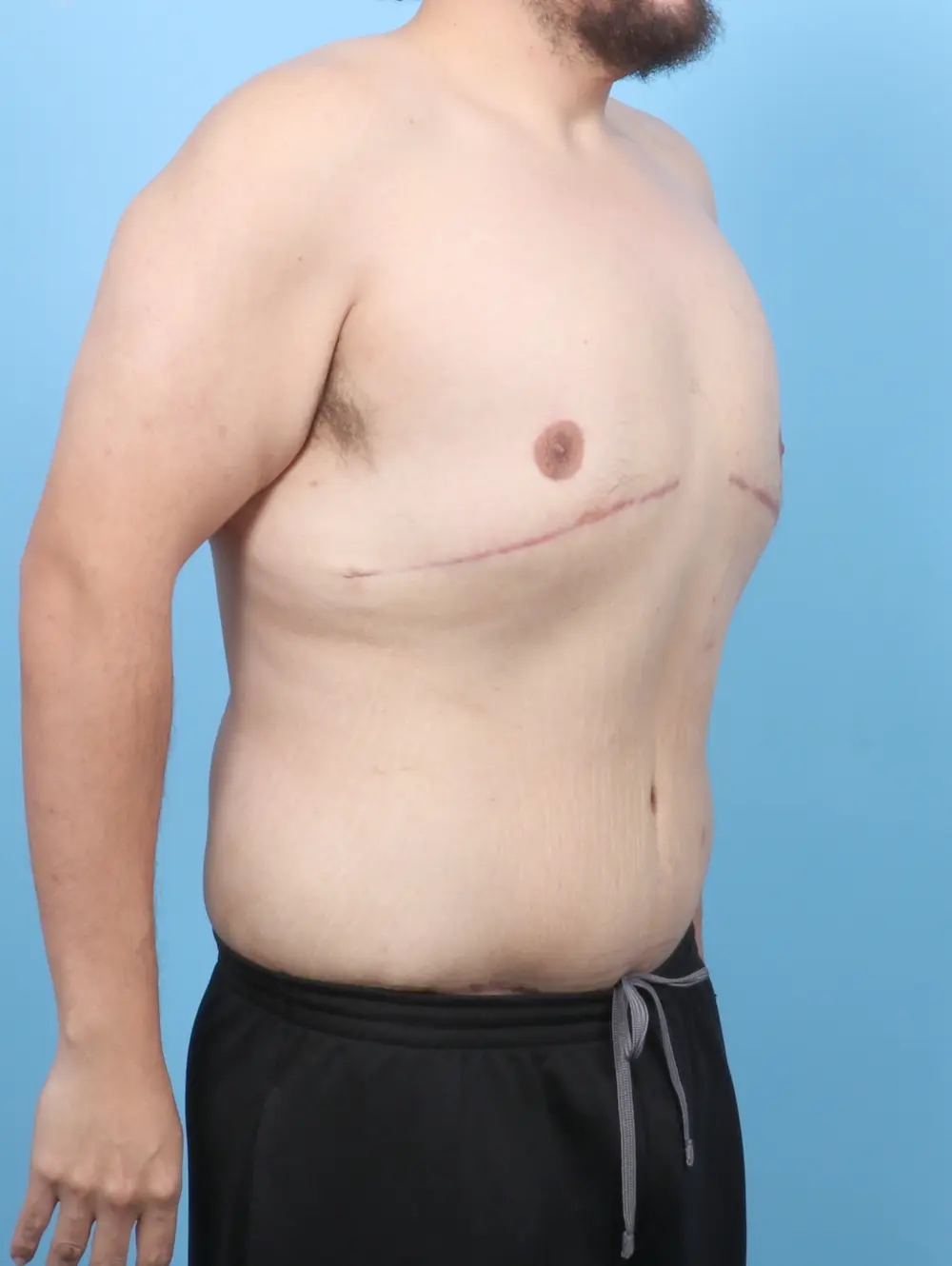 After Weight Loss Patient Photo - Case 53108 - after view-1