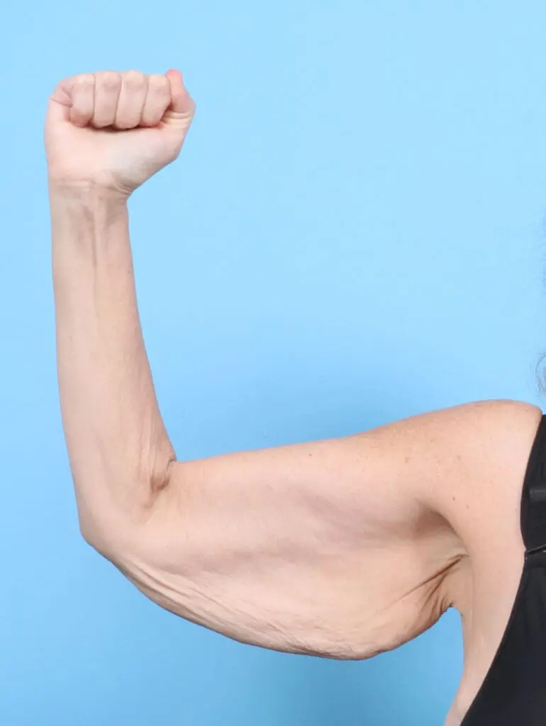 After Weight Loss - Case 53126 - Before