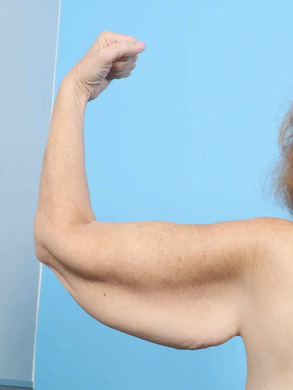 After Weight Loss Patient Photo - Case 53126 - before view-1