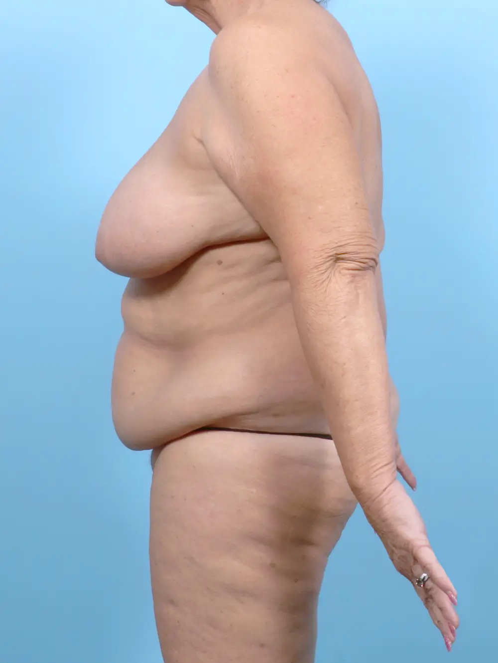 Body Lift Patient Photo - Case 53140 - before view-2