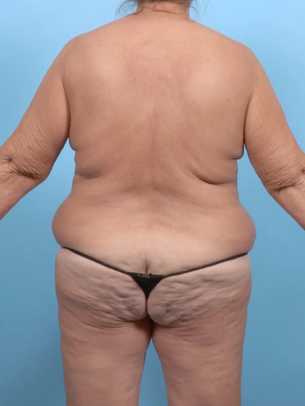 Body Lift Patient Photo - Case 53140 - before view-3