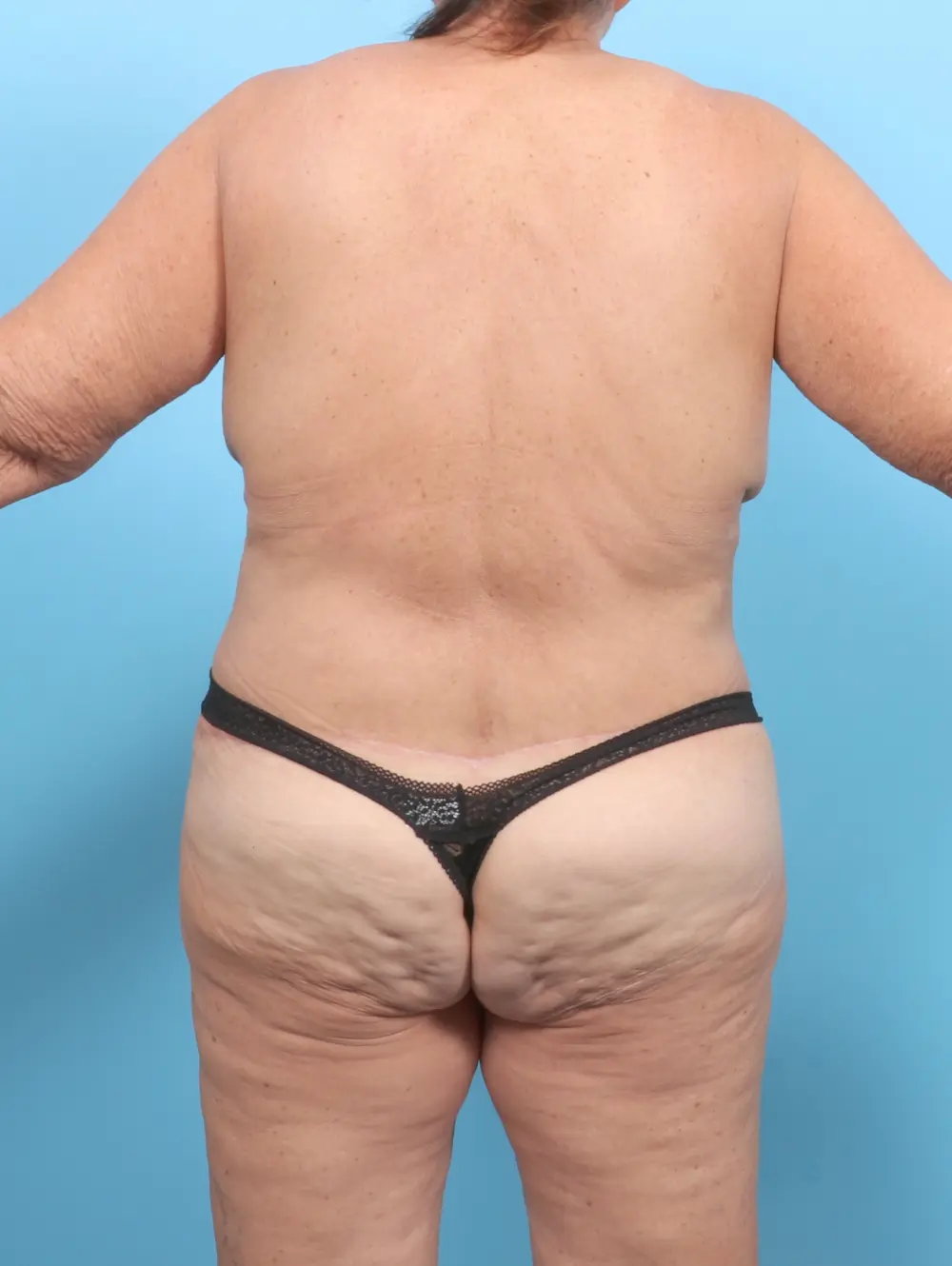 Body Lift Patient Photo - Case 53140 - after view-3