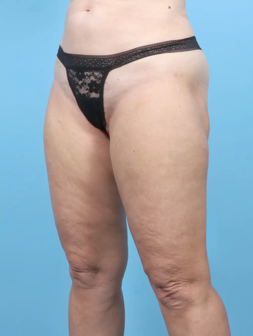Liposuction Patient Photo - Case 53150 - after view-1