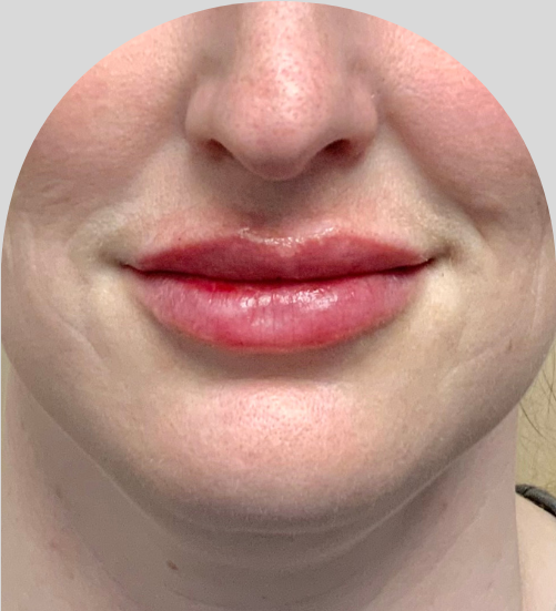 Lip Fillers - Case 53195 - After